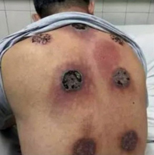 pay cupping therapy 2 jpg 14592543987333660